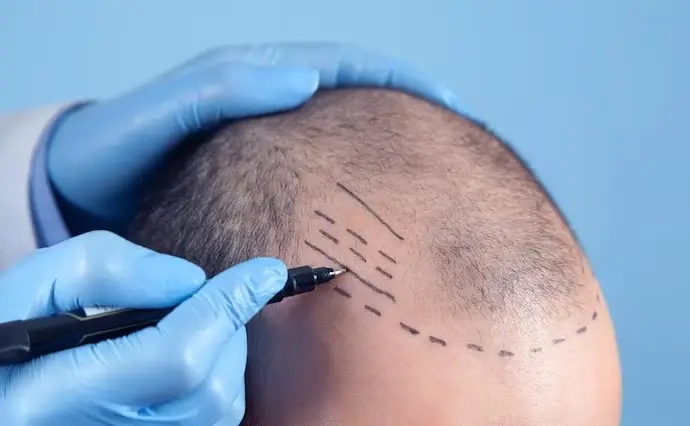 Hair Transplant